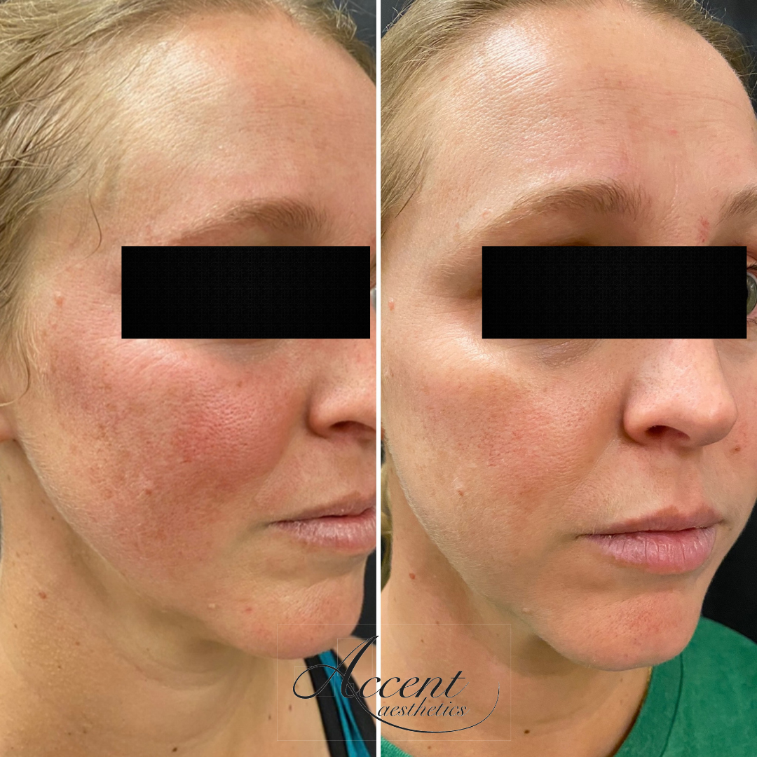AV-Chemical-Peels-1