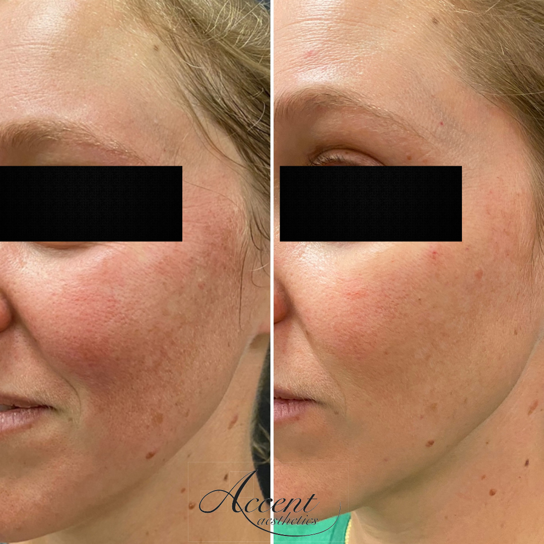 AV-Chemical-peels-2