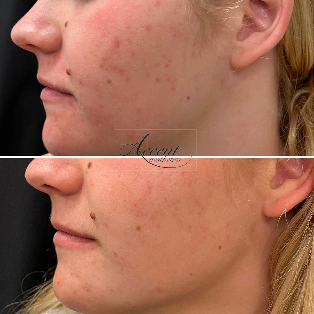 AW-Adva-Acne-1-tx-2