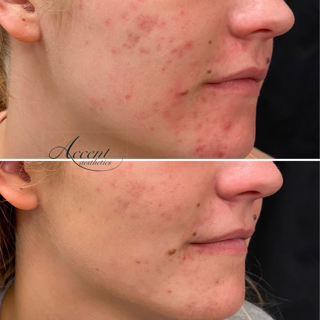 AW-Adva-Acne-1-tx-3