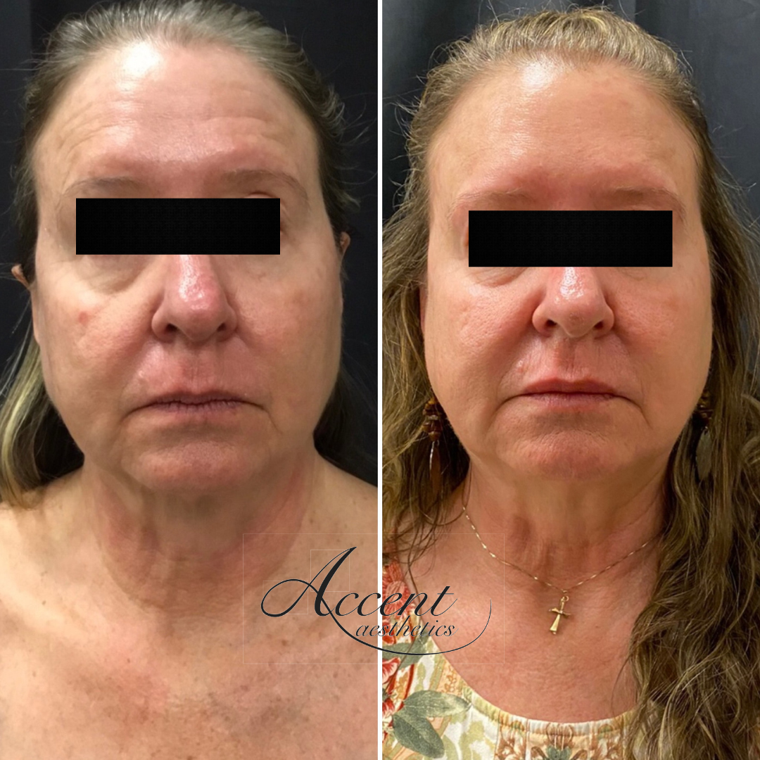 CB-rejuvenation-1