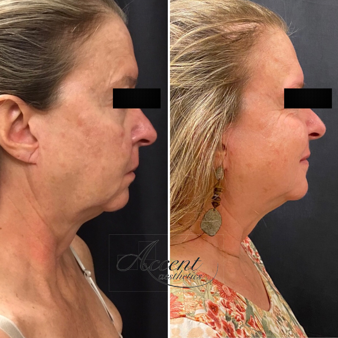 CB-rejuvenation-2