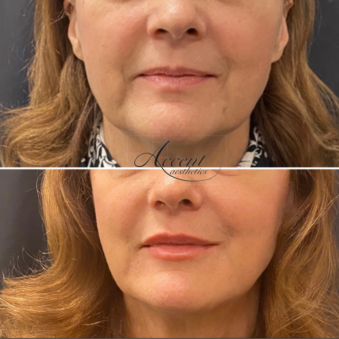 CW-Marionette-lines-and-lips-3