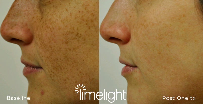 IPL-before-after (1)