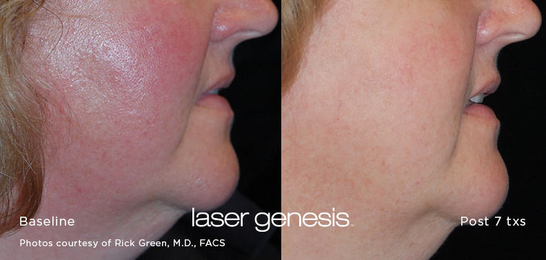 Laser-Genesis-Before-After2