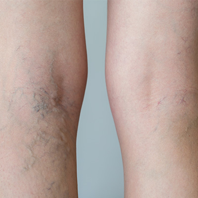 Vein-Treatment