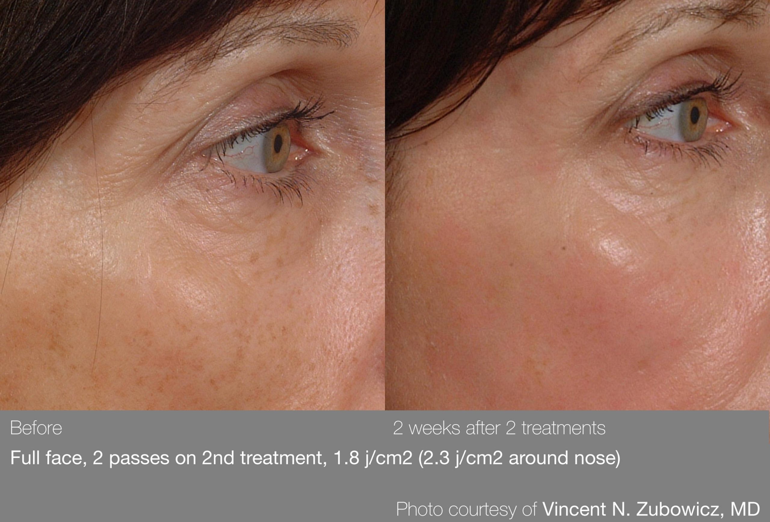 pearl-before-and-after-crowsfeet-and-sundamage-scaled