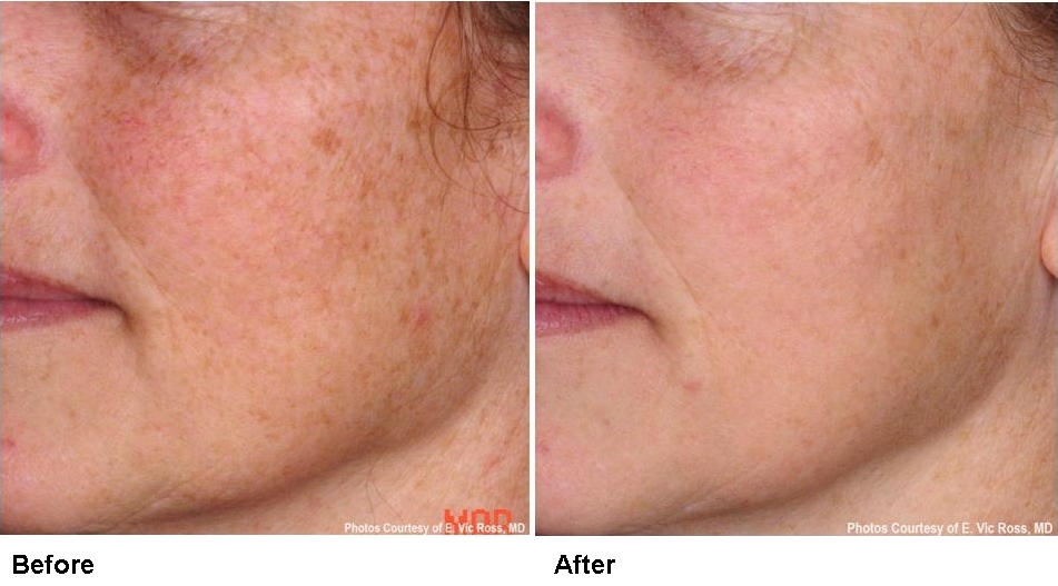 pearl-before-and-after-sundamage